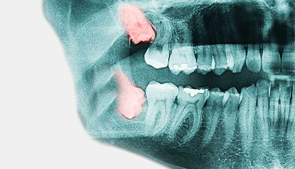 Araştırm--Gelecek-nesiller-20-yaş-dişleri-olmadan-doğabilir