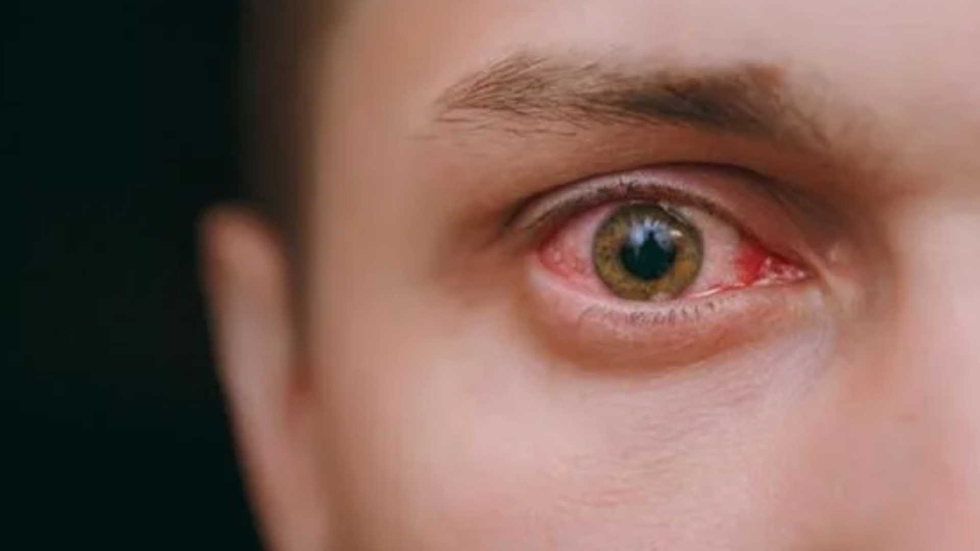 Koronavirüs belirtileri gözlerde de görülebiliyor!