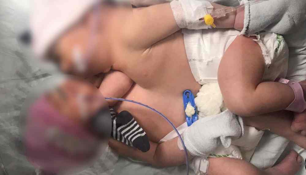 60 doktor katıldı_ Yapışık ikizler 11 saatlik ameliyatla ayrıldı