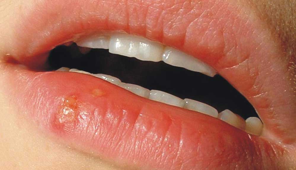 Bilim-insanlari-açikladi-Uçuk-neden-olur-