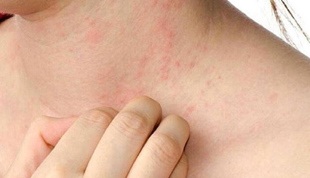 Evde karantina, uyuz vakalarını 2 buçuk katına çıkardı