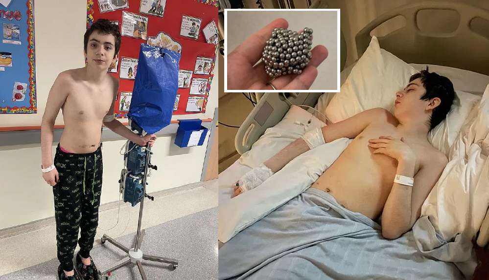 İngiltere’de çocuğun midesinden 54 adet mıknatıslı bilye çıktı