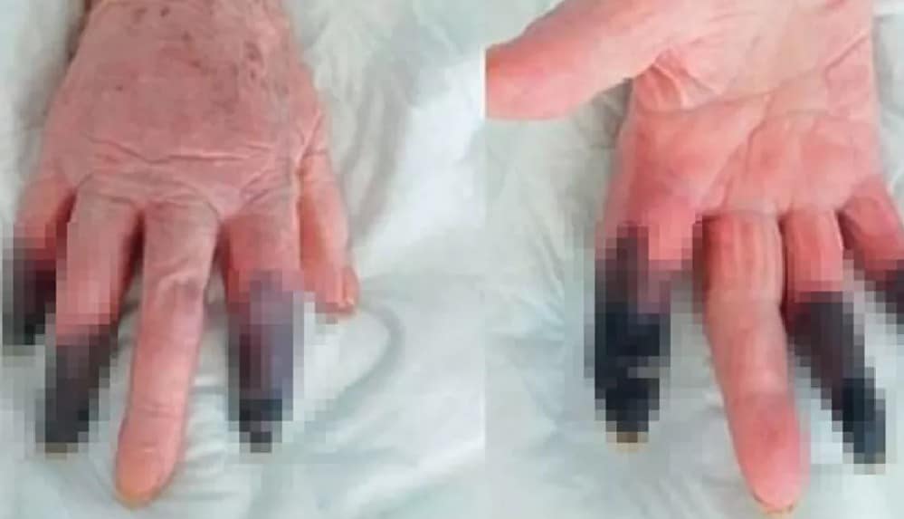 İtalya’da koronavirüs hastası kadın kangren oldu_ 3 parmağı kesildi