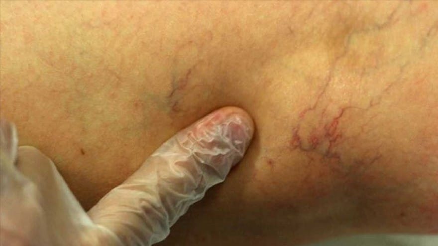 Varis ölümcül olabilir