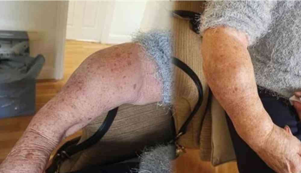 İngiltere’de sağlık skandalı! 18 aydır kırık kolla acılar içinde kıvranıyor