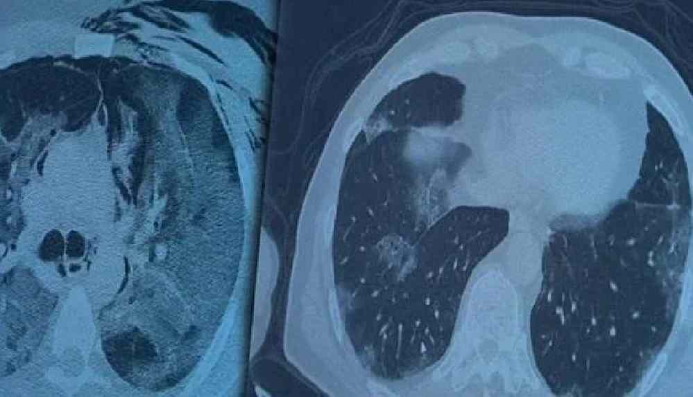 Aşı olduktan sonra koronavirüse yakalanan hastaların akciğer filmi paylaşıldı
