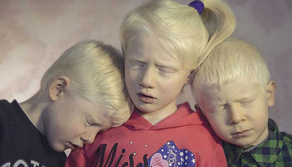 Albinizmli-bireyler-güneşten-koruyucu-kremleri-için-devletten-destek-bekliyor