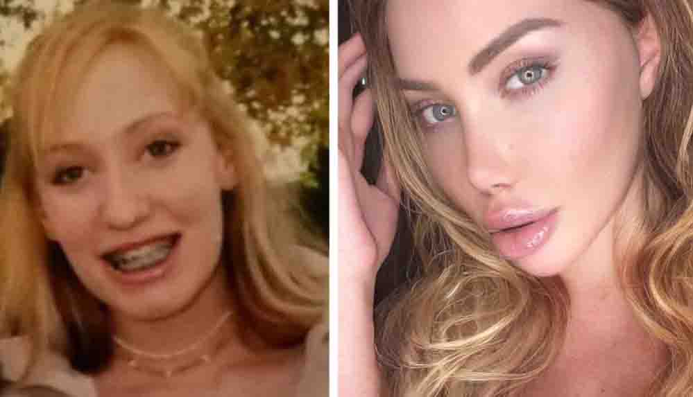 Estetikleri-icin-8-milyon-lira-harcadi-Uyandigimda-agzim-kanlar-icindeydi