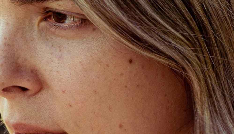 Vücuttaki benlerin gösterdiği değişimlere dikkat edilmesi gerekiyor