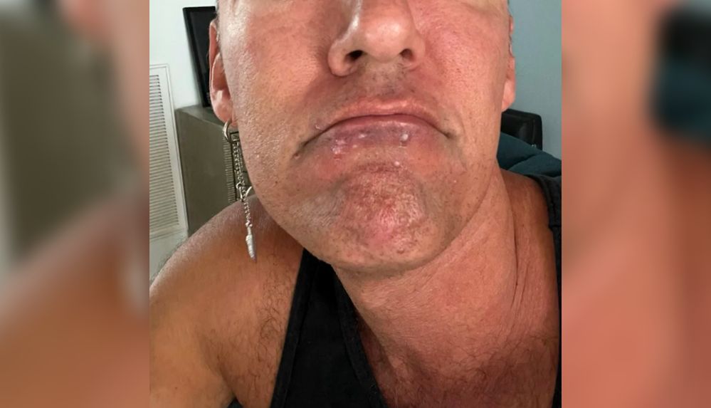 maymun çiçeği hastalığı