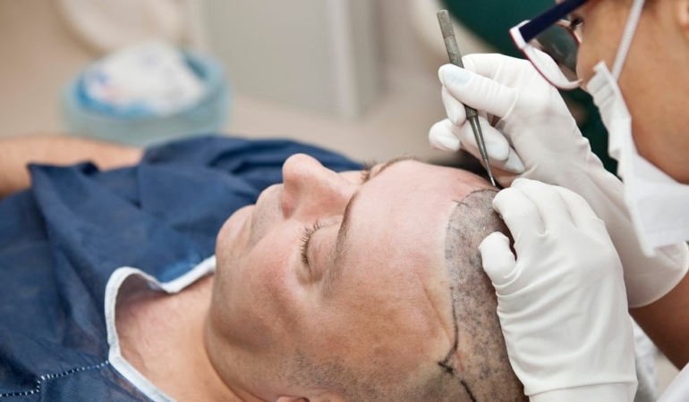 İngiltere Mahkemesinden kritik karar: İngilizler saç ekimi için Türkiye’ye akın edecek!