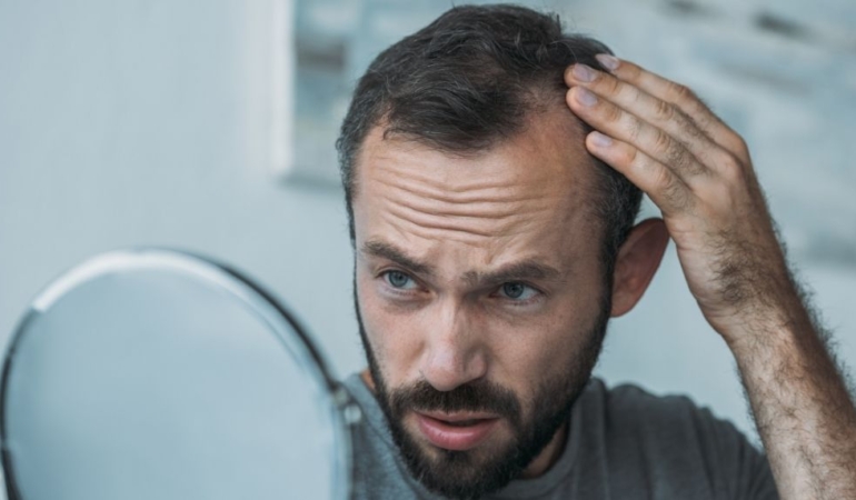 Saç dökülmesine karşı devrim yaratacak çözüm: Ne ilaç ne saç ekimi gerekiyor