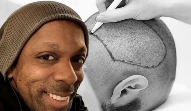 İstanbul’da yaptırdığı saç ekimi sonu oldu!